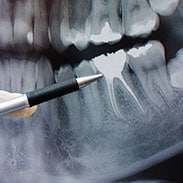 Tooth Root